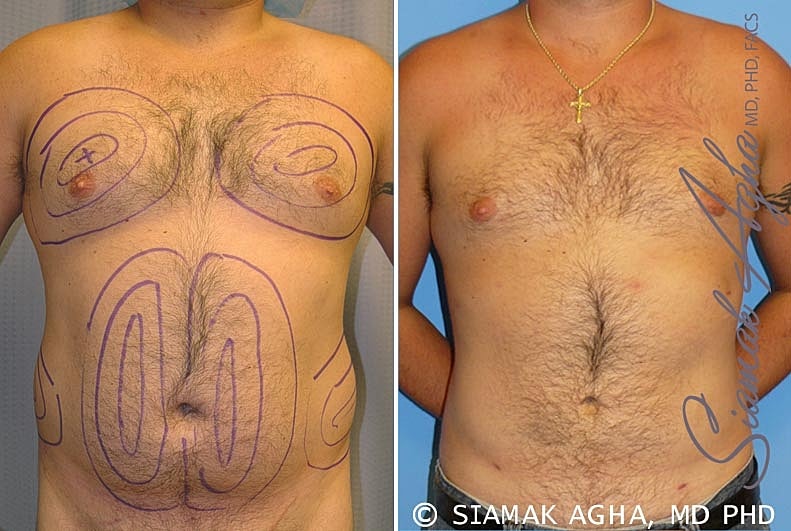 Male Breast Reduction Before & After