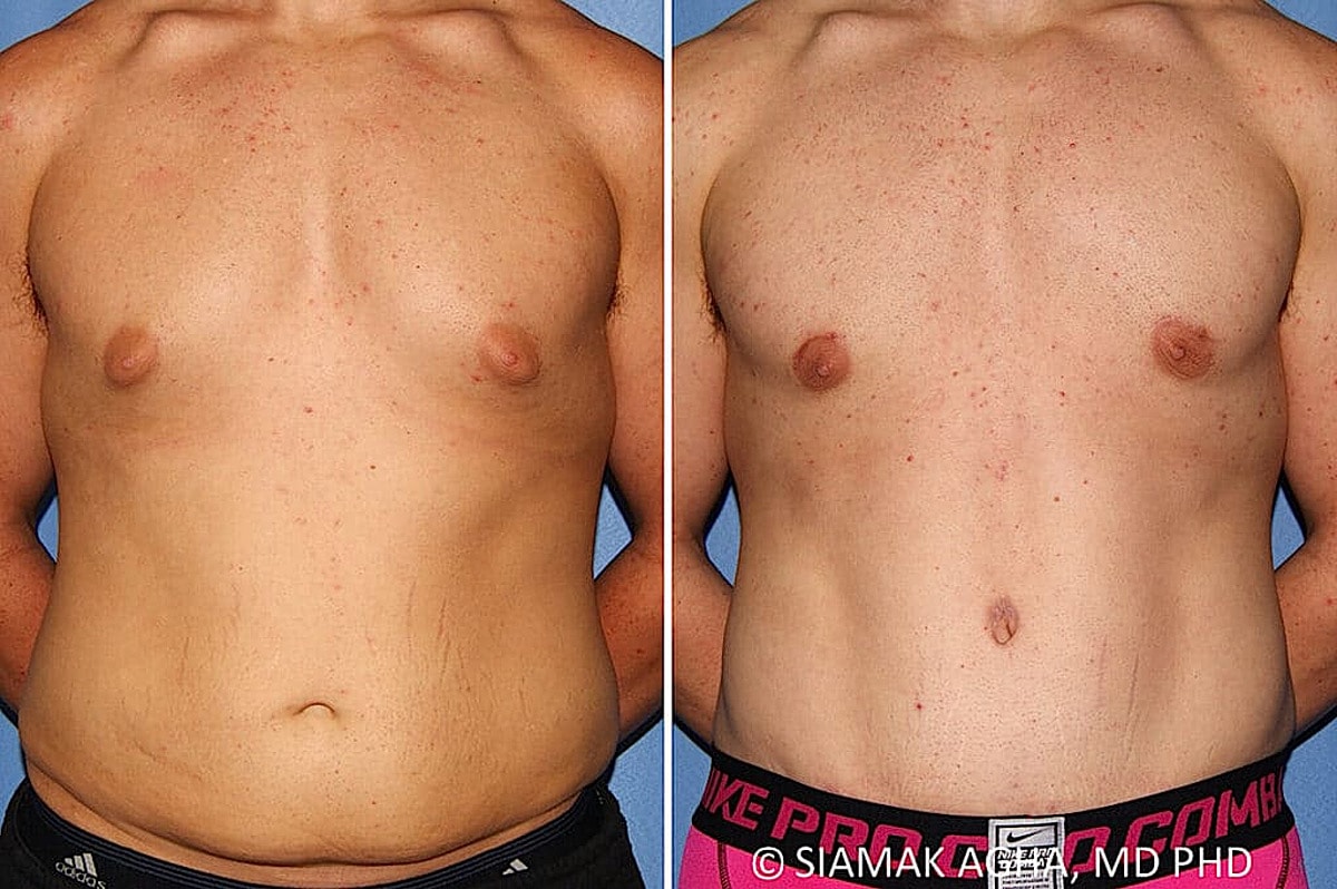 Male Breast Reduction Before & After