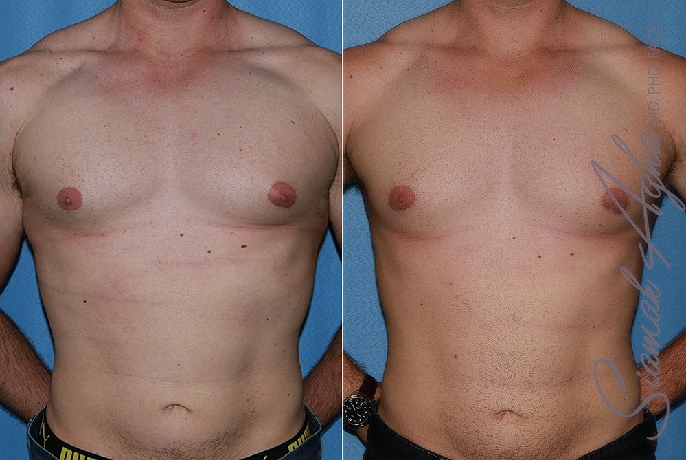 Male Breast Reduction Before & After