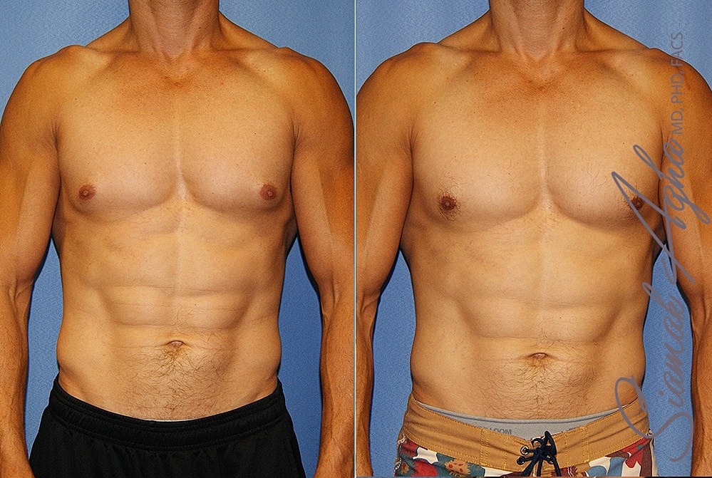 Male Breast Reduction Before & After