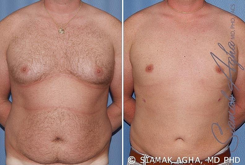 Male Breast Reduction Before & After