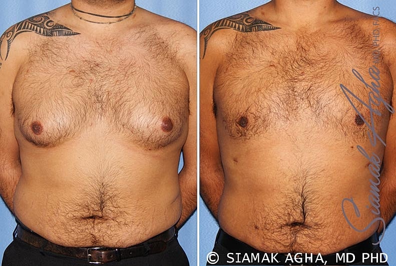 Male Breast Reduction Before & After