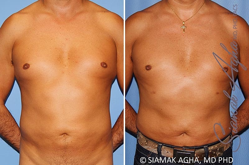 Male Breast Reduction Before & After