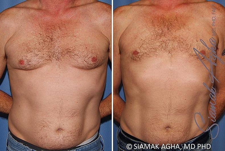 Male Breast Reduction Before & After