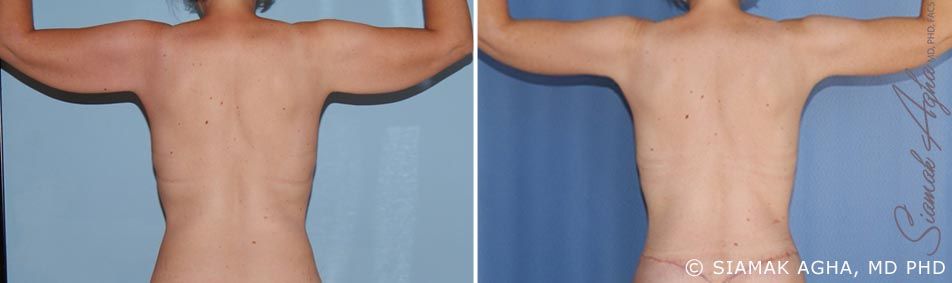 Arm Lift Before & After