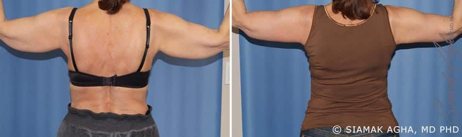 Arm Lift Before & After