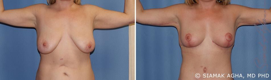 Arm Lift Before & After