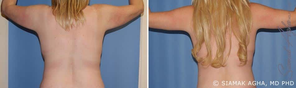Arm Lift Before & After