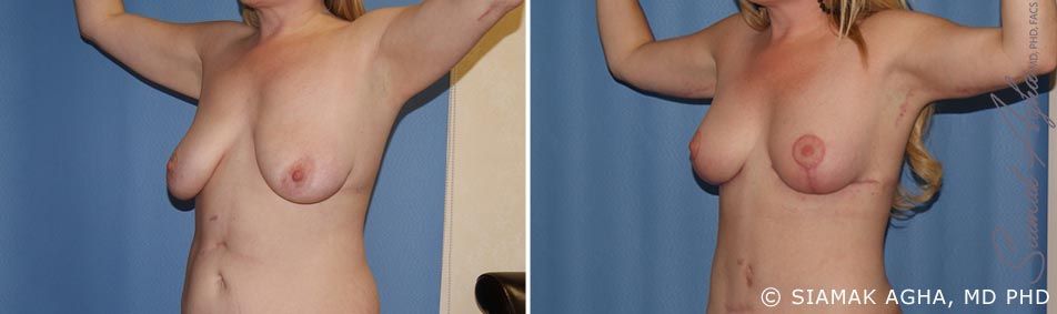 Arm Lift Before & After