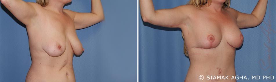 Arm Lift Before & After