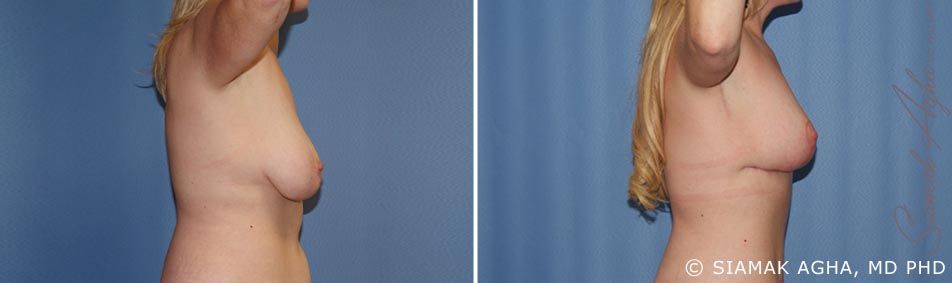 Arm Lift Before & After