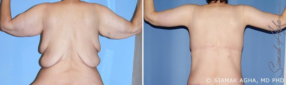 Arm Lift Before & After