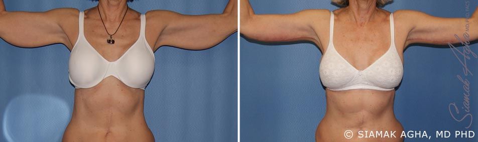 Arm Lift Before & After