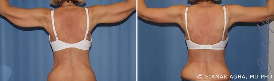Arm Lift Before & After