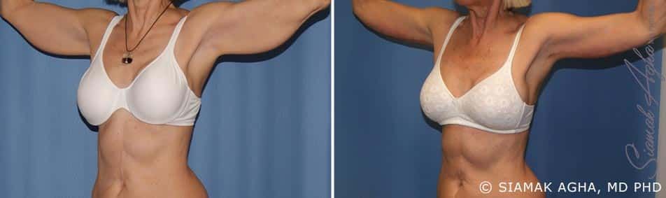 Arm Lift Before & After