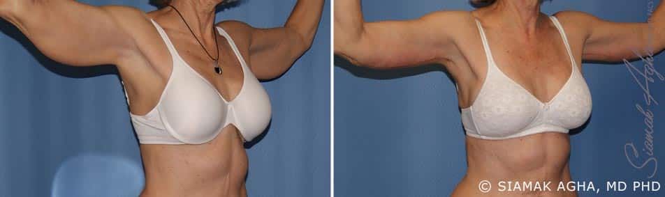 Arm Lift Before & After