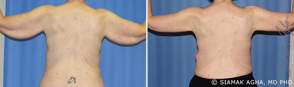 Arm Lift Before & After