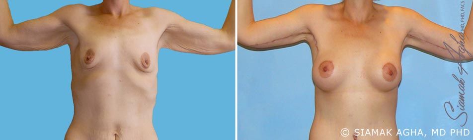 Arm Lift Before & After