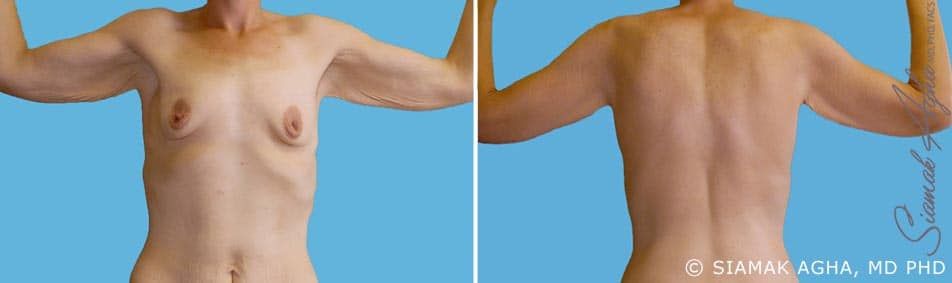 Arm Lift Before & After