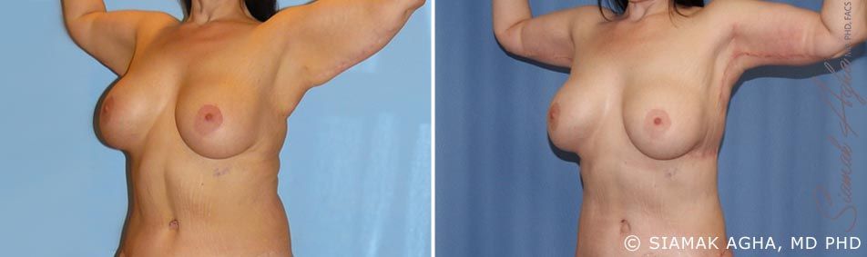 Arm Lift Before & After