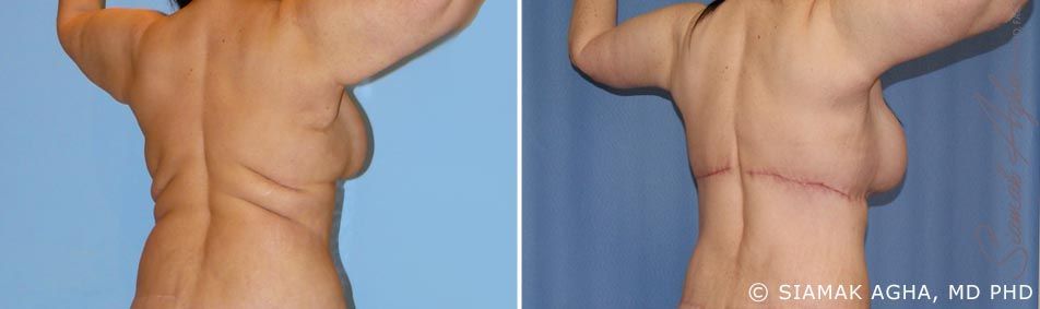 Arm Lift Before & After