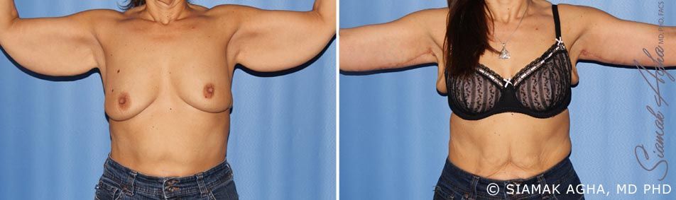 Arm Lift Before & After