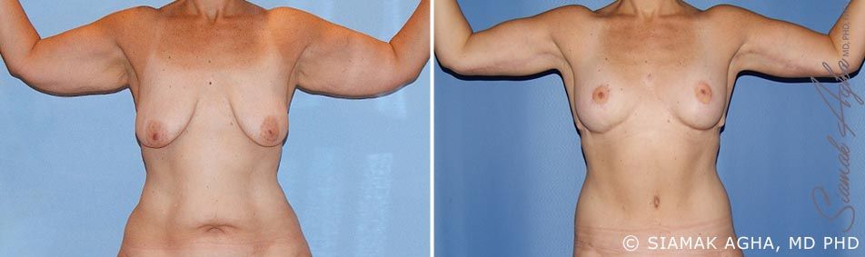 Arm Lift Before & After