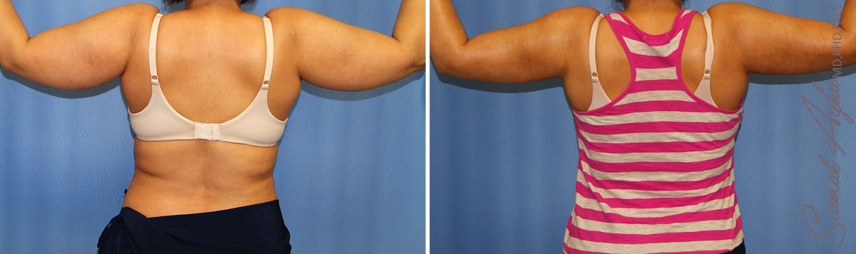 Arm Lift Before & After