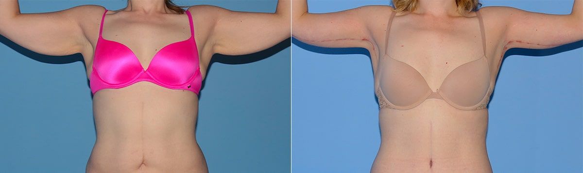 Arm Lift Before & After