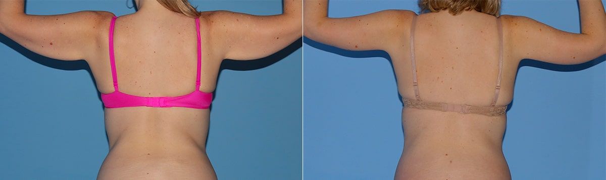 Arm Lift Before & After