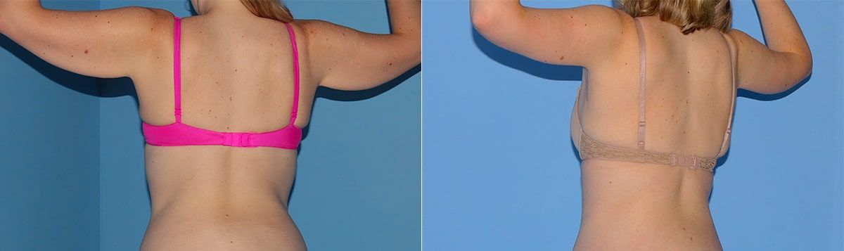 Arm Lift Before & After