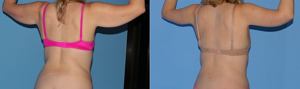 Arm Lift Before & After