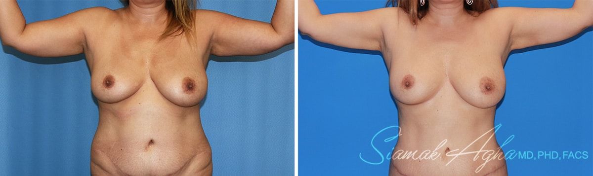 Arm Lift Before & After