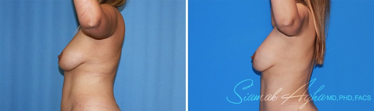 Arm Lift Before & After