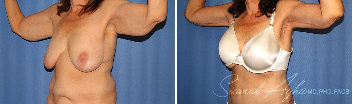 Arm Lift Before & After