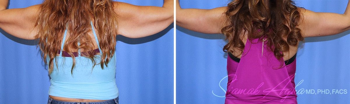 Arm Lift Before & After