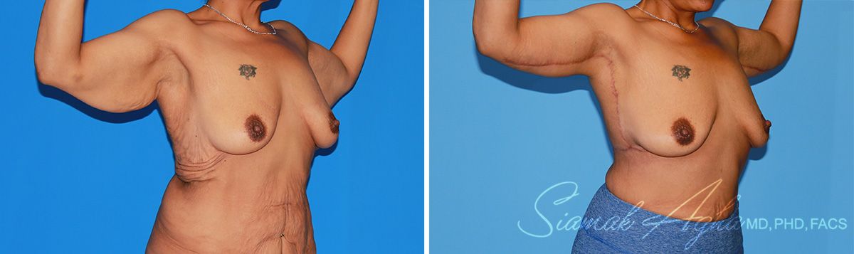 Arm Lift Before & After