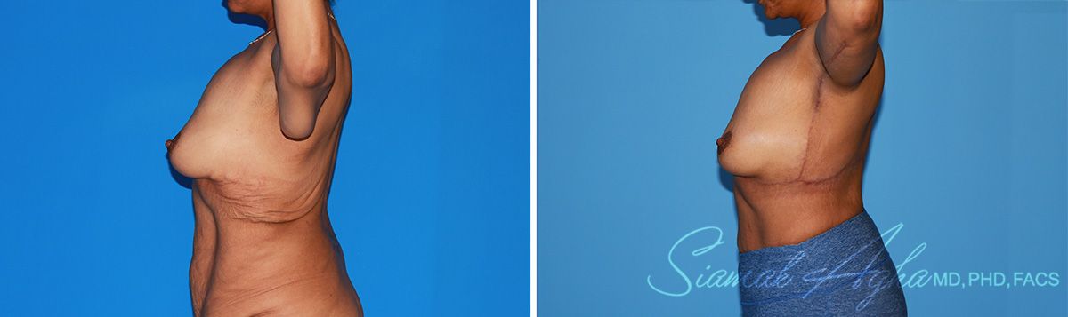 Arm Lift Before & After