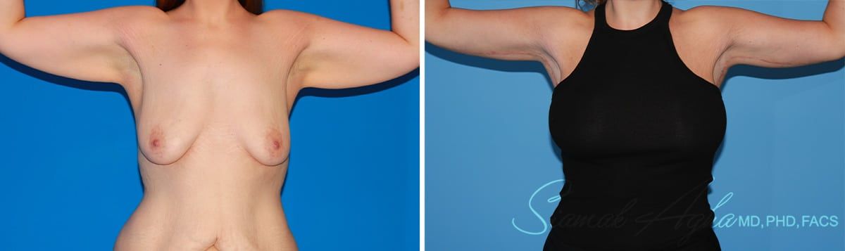 Arm Lift Before & After