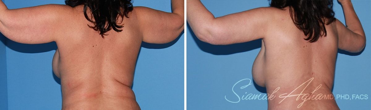 Arm Lift Before & After