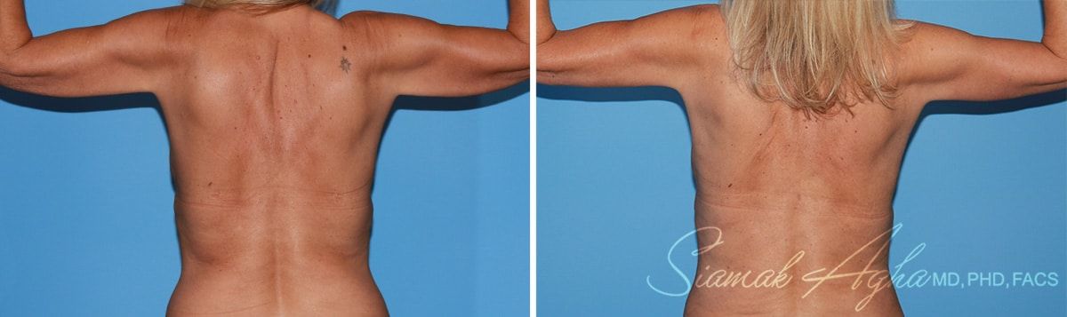 Arm Lift Before & After