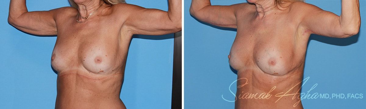 Arm Lift Before & After