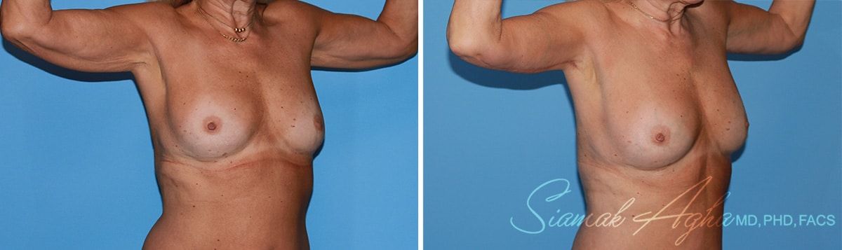 Arm Lift Before & After