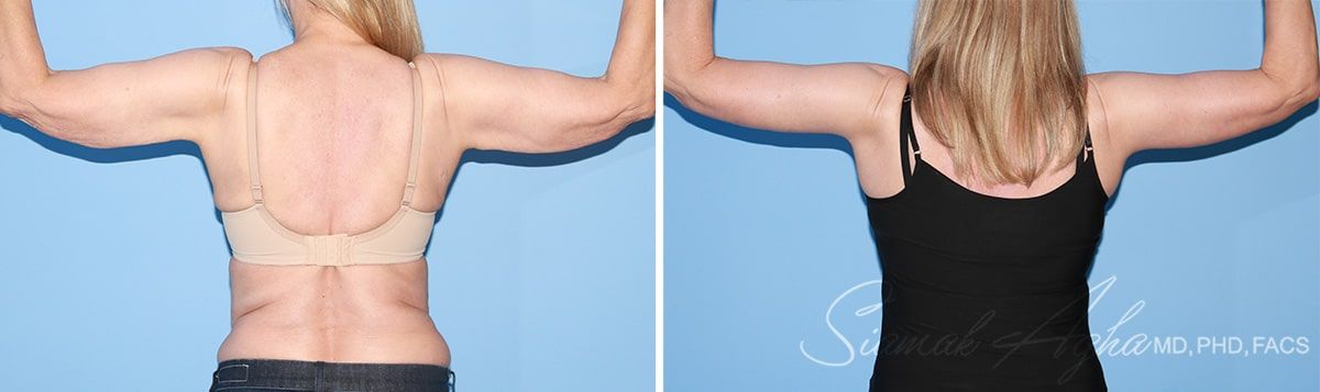 Arm Lift Before & After