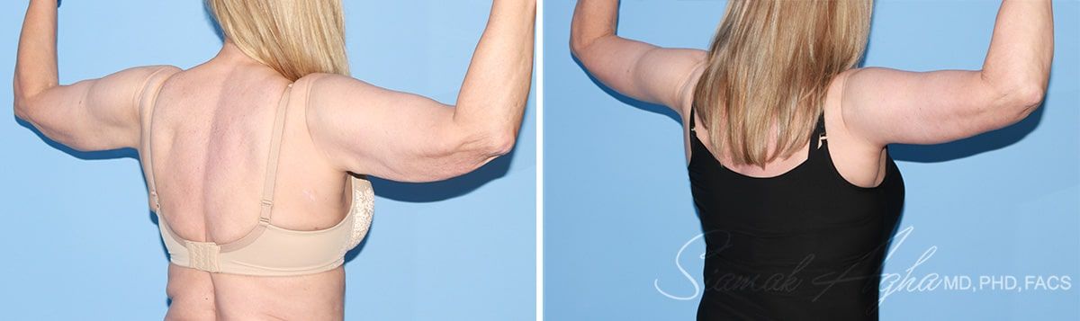 Arm Lift Before & After