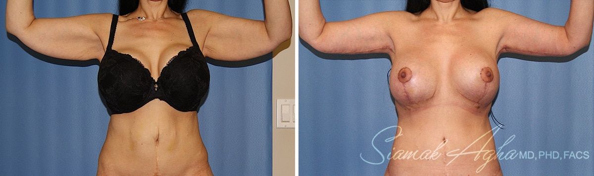 Arm Lift Before & After