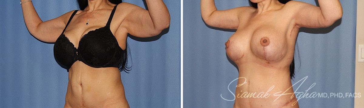 Arm Lift Before & After