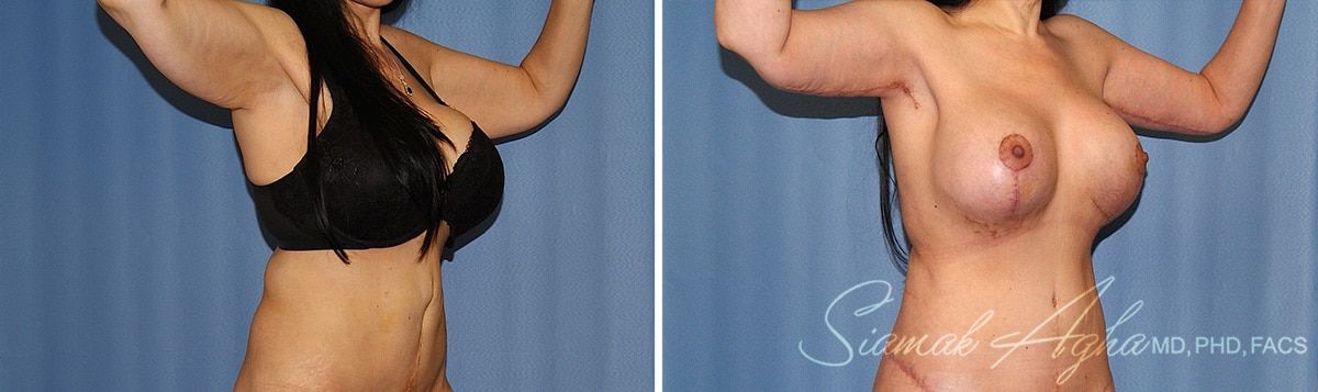 Arm Lift Before & After