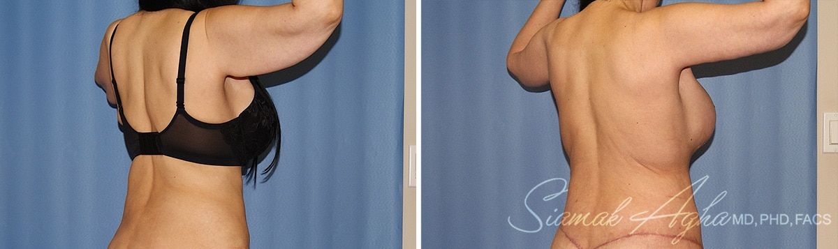 Arm Lift Before & After