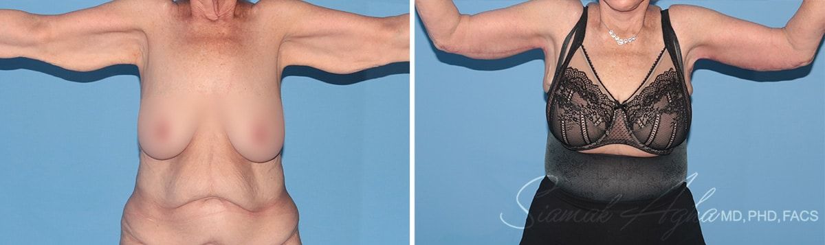 Arm Lift Before & After